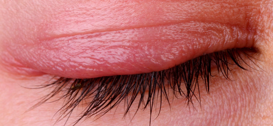 Blepharitis